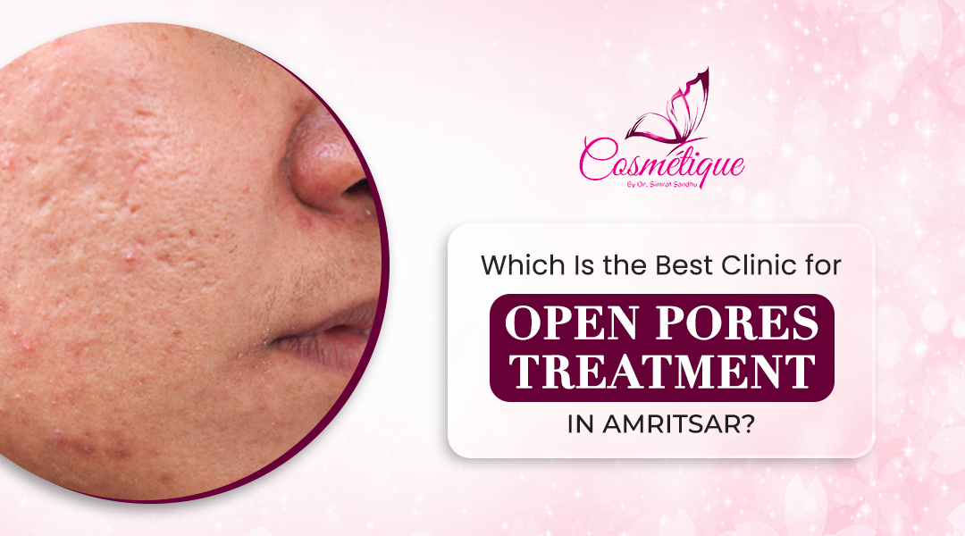 Which Is the Best Clinic for Open Pores Treatment in Amritsar?